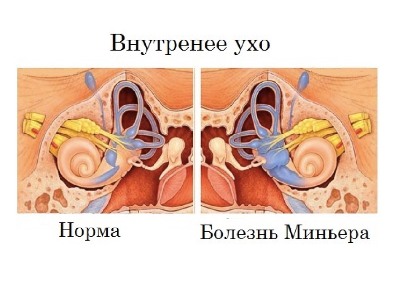 Нарушение внутреннего уха. Болезнь Меньера гидропс. Заболевания внутреннего уха. Внутреннее ухо заболевания. Заболевания органов слуха болезнь Меньера.