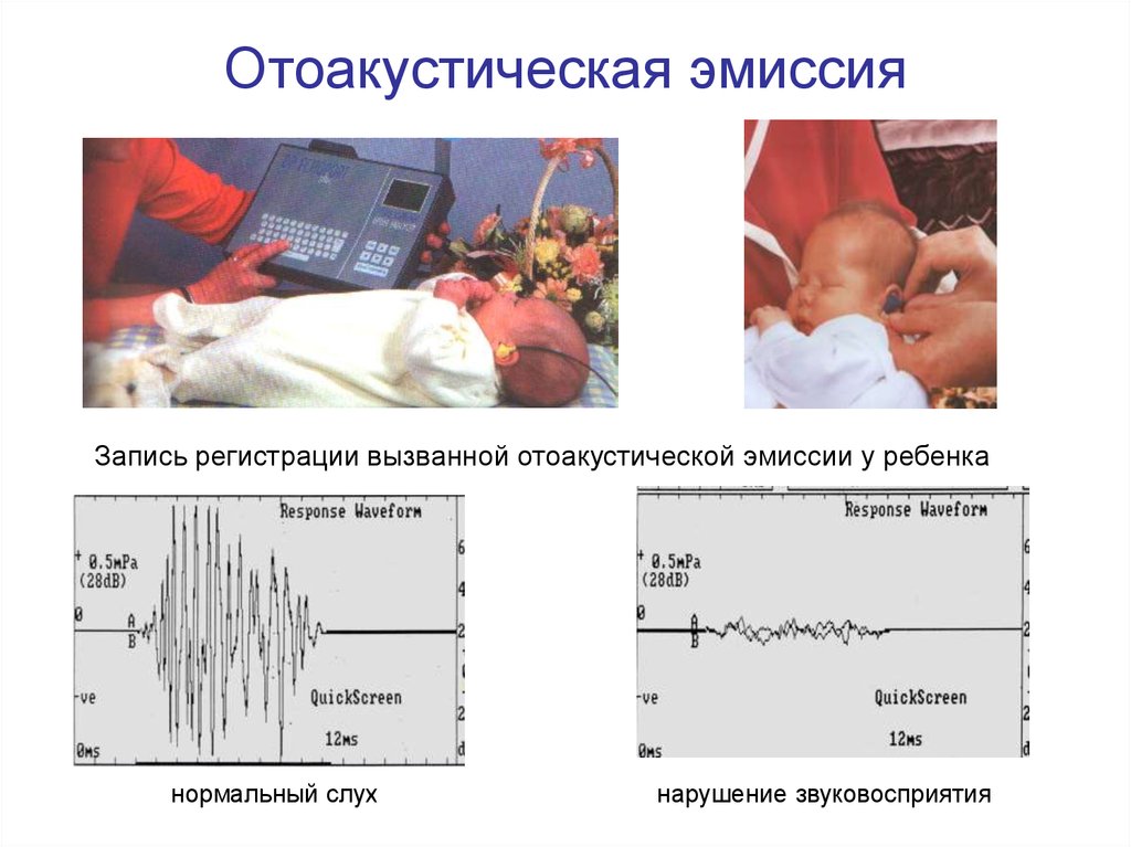 Как проверить слух у новорожденного. Отоакустическая эмиссия скрининг у новорожденных. Отоакустическая эмиссия при нейросенсорной тугоухости. Тест отоакустической эмиссии расшифровка у детей норма. Аудиологический скрининг новорожденного.